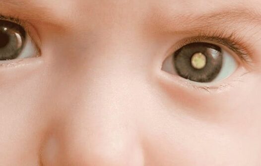 Saiba mais sobre o retinoblastoma, câncer da filha de Tiago Leifert