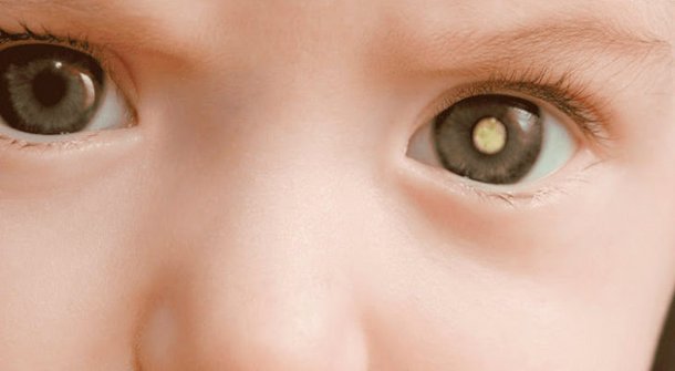 Campanha de prevenção ao retinoblastoma terá ações gratuitas em Fortaleza neste fim de semana 