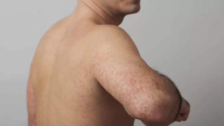 Terceiro caso de varíola dos macacos é confirmado no Ceará