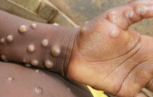 Governo cria comissão para acompanhar casos de varíola dos macacos