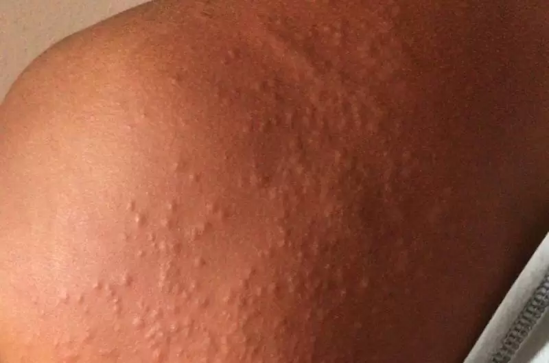 Recife investiga surto de lesões na pele que provocam coceira