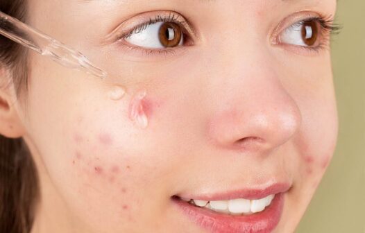 5 erros para não cometer quando estiver com acne ativa