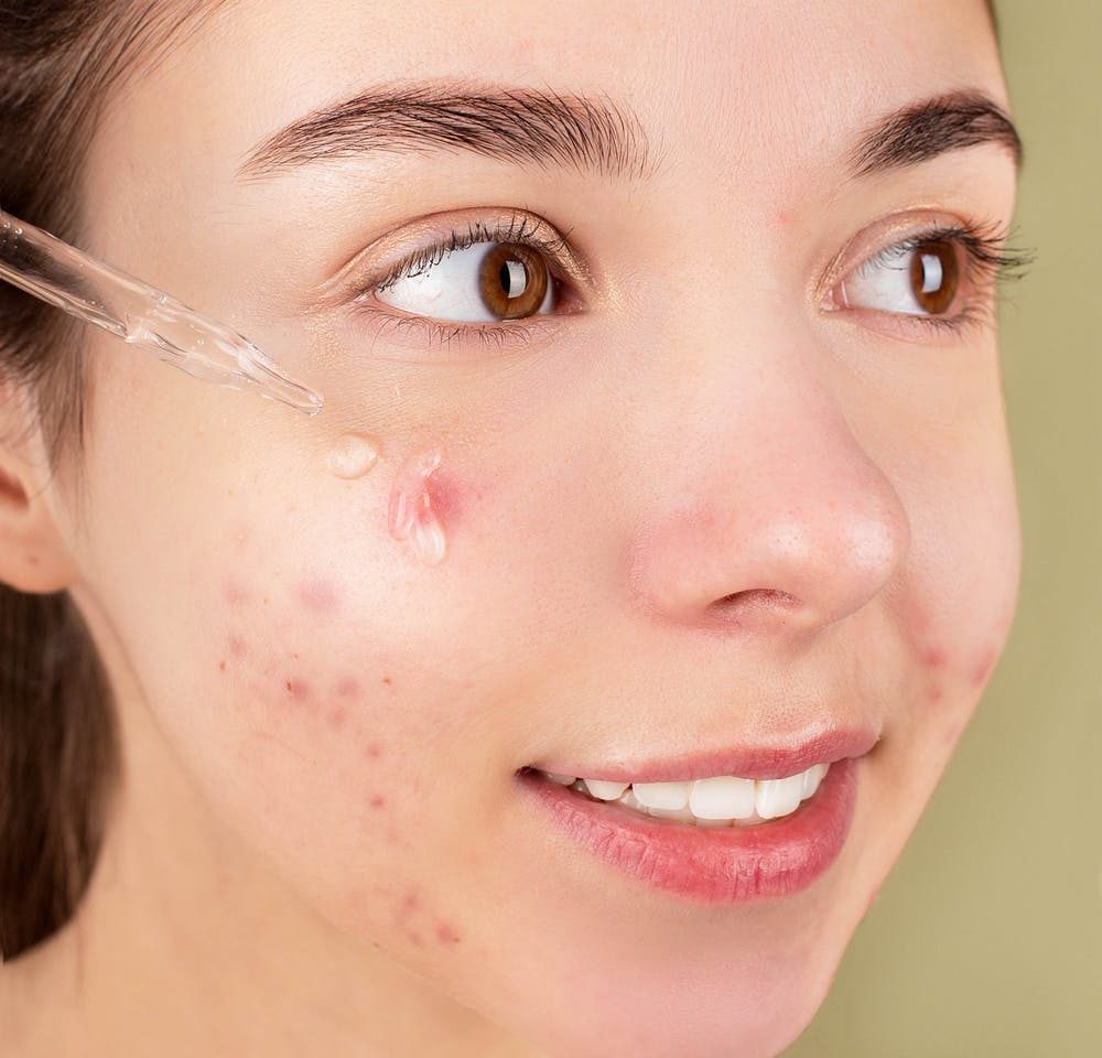 5 erros para não cometer quando estiver com acne ativa