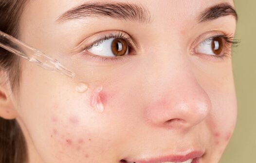 Entenda mais sobre melasma