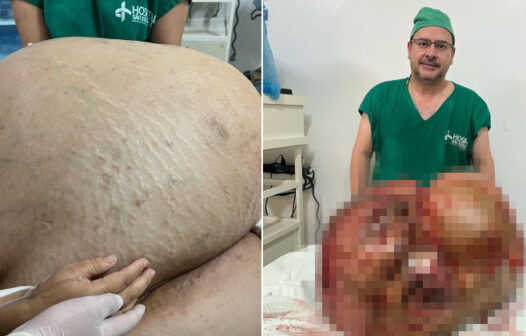 Mulher pensou que estava engordando, mas tinha um tumor de 46 kg