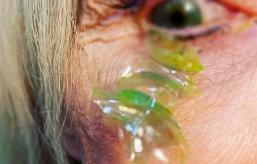 Imagens fortes: médica remove 23 lentes de contato de olho de paciente esquecida