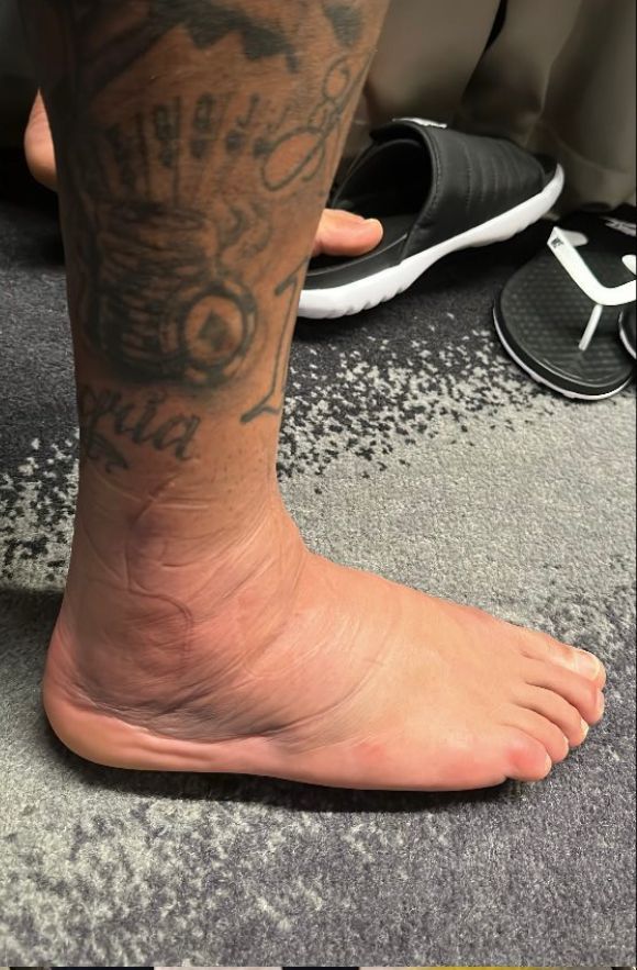 Neymar Jr posta foto do pé lesionado em suas redes sociais