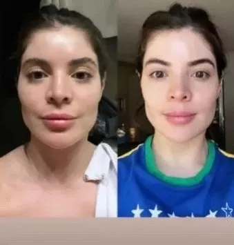 Antes ou depois? Gkay tira preenchimento e exibe resultado na web