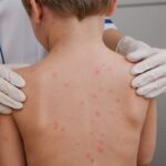 Ceará registra 65 casos de meningite e sete mortes em 2024