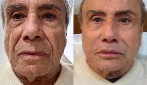 Stênio Garcia exibe resultado de harmonização facial