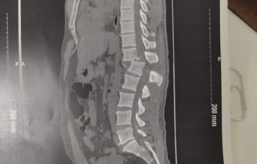 Após 4 horas de cirurgia, aluno atingido por aparelho em academia tem quadro de saúde estável