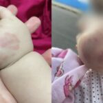 Bebê volta de creche com hematomas no rosto e mãe denuncia: “Irresponsabilidade!”