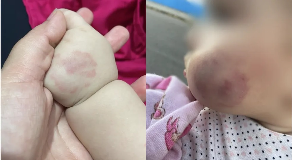 Bebê volta de creche com hematomas no rosto e mãe denuncia: “Irresponsabilidade!”