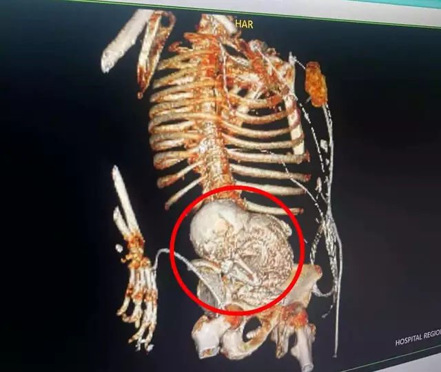 Litopedia: entenda o caso do feto que ficou calcificado no corpo da mãe por 56 anos