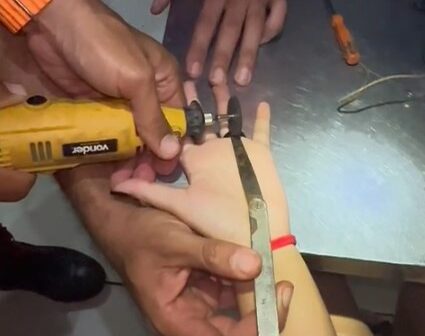 Corpo de Bombeiros remove anel preso em dedo de adolescente em Fortaleza