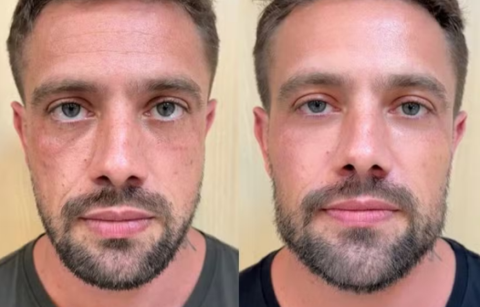 Rafael Cardoso passa por harmonização facial e volta à web