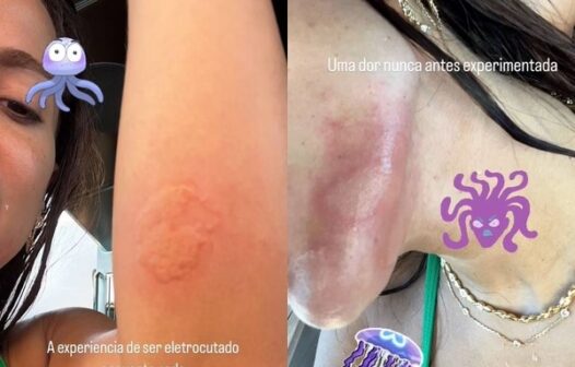 Anitta diz ter sido ‘eletrocutada’ por água-viva, perde unha e vai parar no hospital