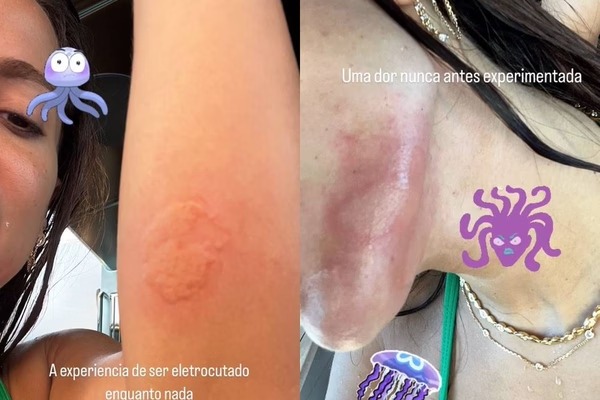 Anitta diz ter sido 'eletrocutada' por água-viva, perde unha e vai parar no hospital