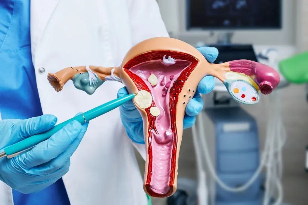 Miomas uterinos: como identificar e quais são as opções de tratamento?
