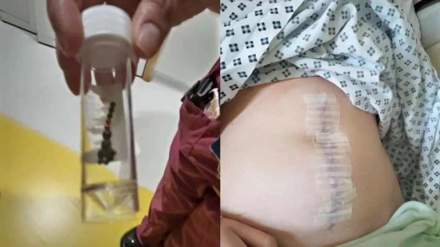 Adolescente tem parte do intestino removido após fazer desafio do TikTok
