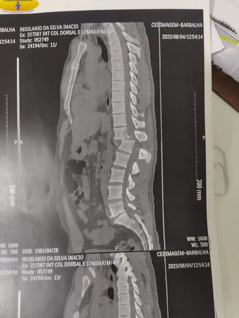 Após 4 horas de cirurgia, aluno atingido por aparelho em academia tem quadro de saúde estável