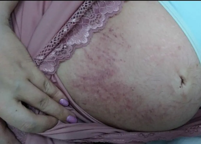 Recém-nascido morre após manobra não recomendada durante o parto